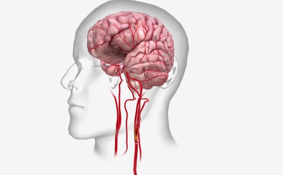 Electrohomeopathy for Neurological Conditions